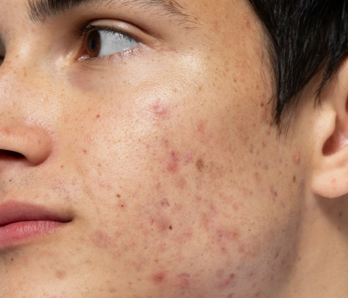 Close-up of varied acne scarring and textural damage on the cheek