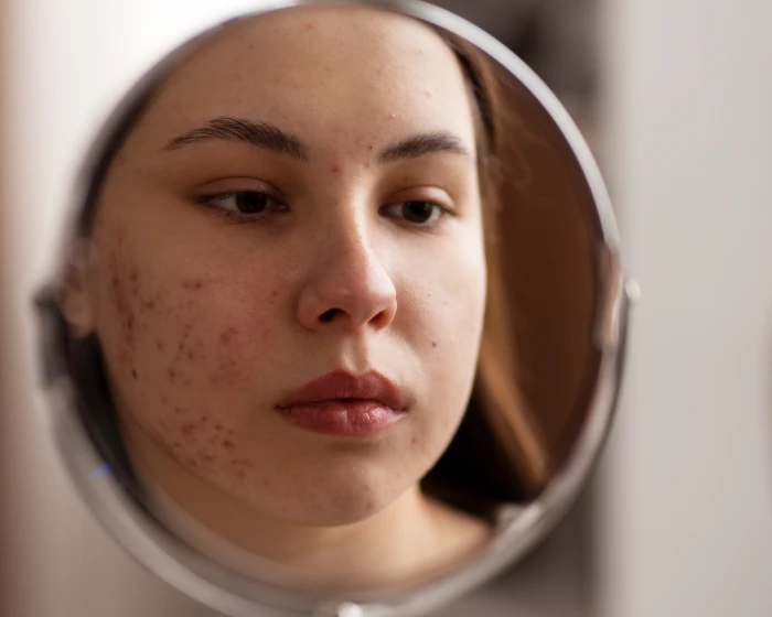 A young woman examining acne and early scarring on her cheek in a mirror