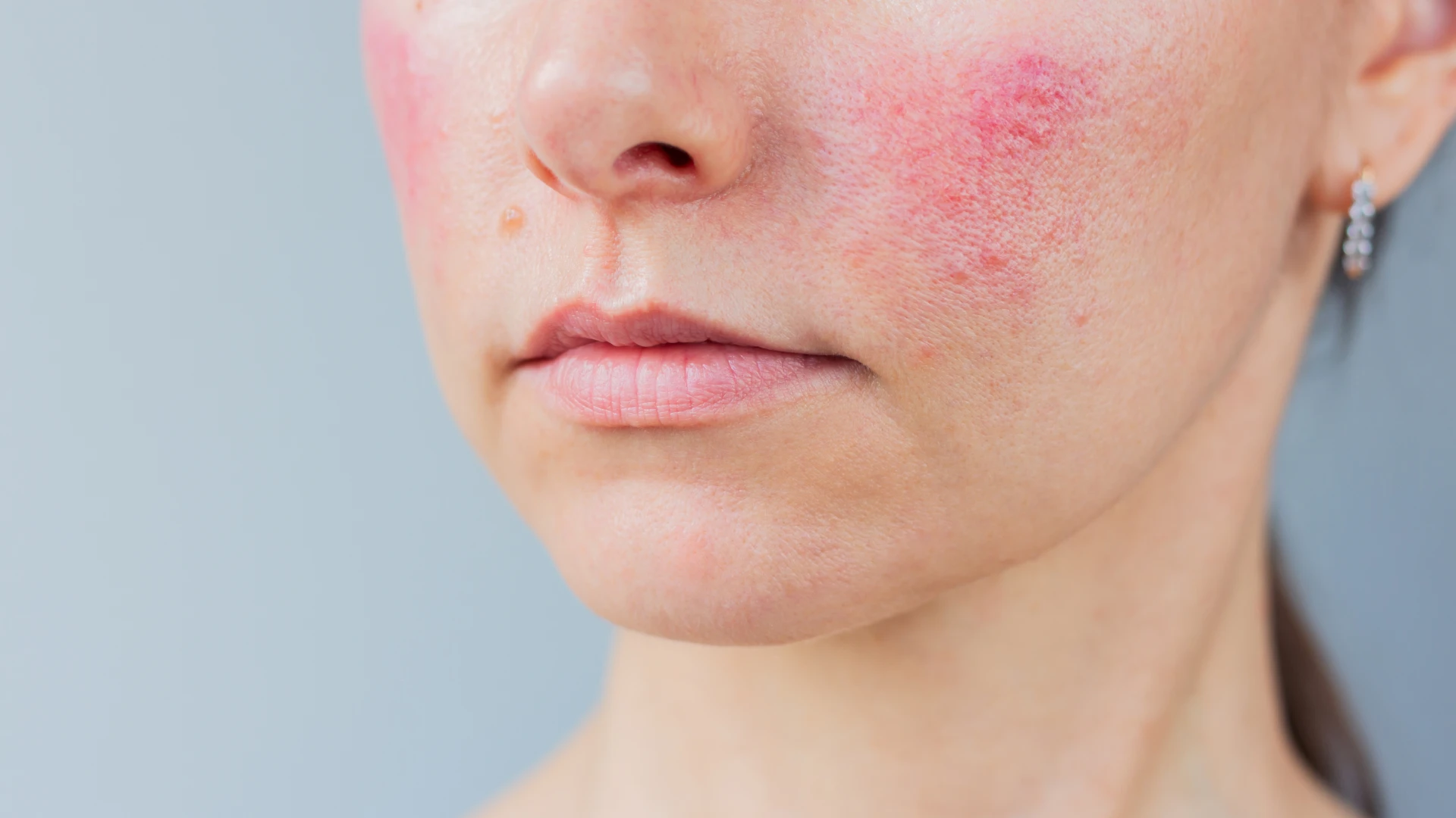 Close-up of facial redness and visible rosacea on the cheek, treated at The Skin Firm Sheffield