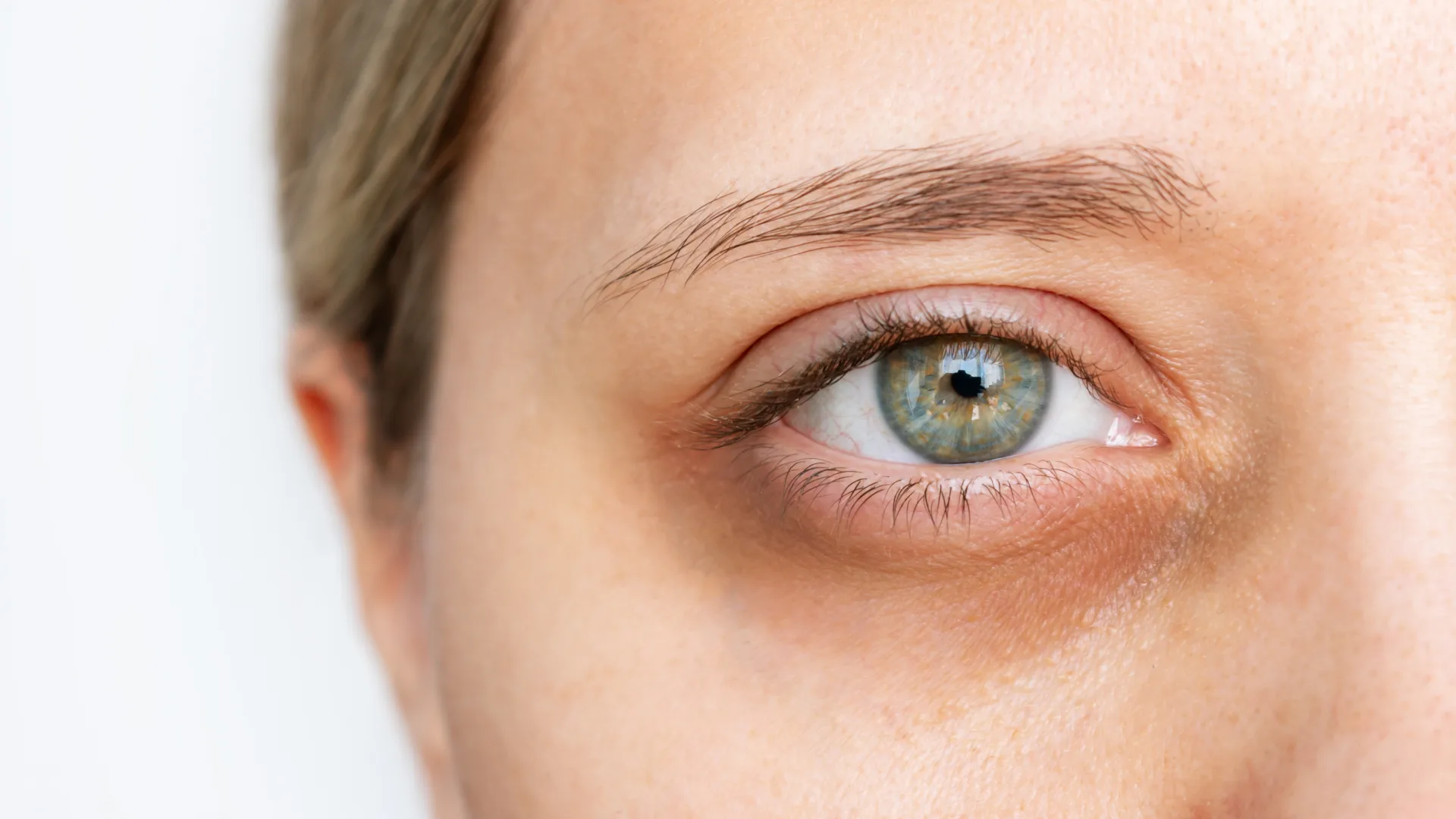 Close-up of an eye showing a dark circle and under-eye shadow, treated at The Skin Firm Sheffield