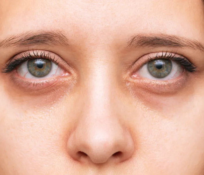 Close-up of visible dark circles under both eyes