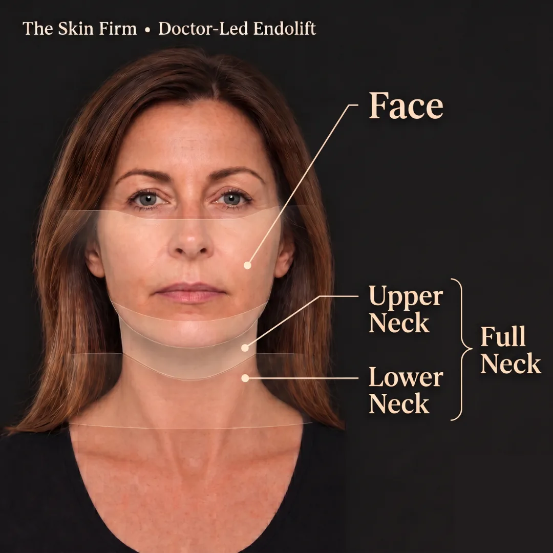 Endolift treatment area map marking the face, upper neck and lower neck, with the upper and lower neck together making the full neck