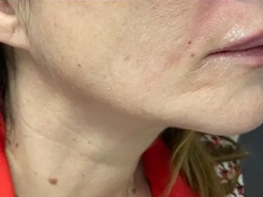 Jawline, After before and after at The Skin Firm