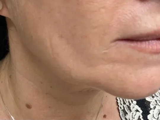 Jawline, Before before and after at The Skin Firm