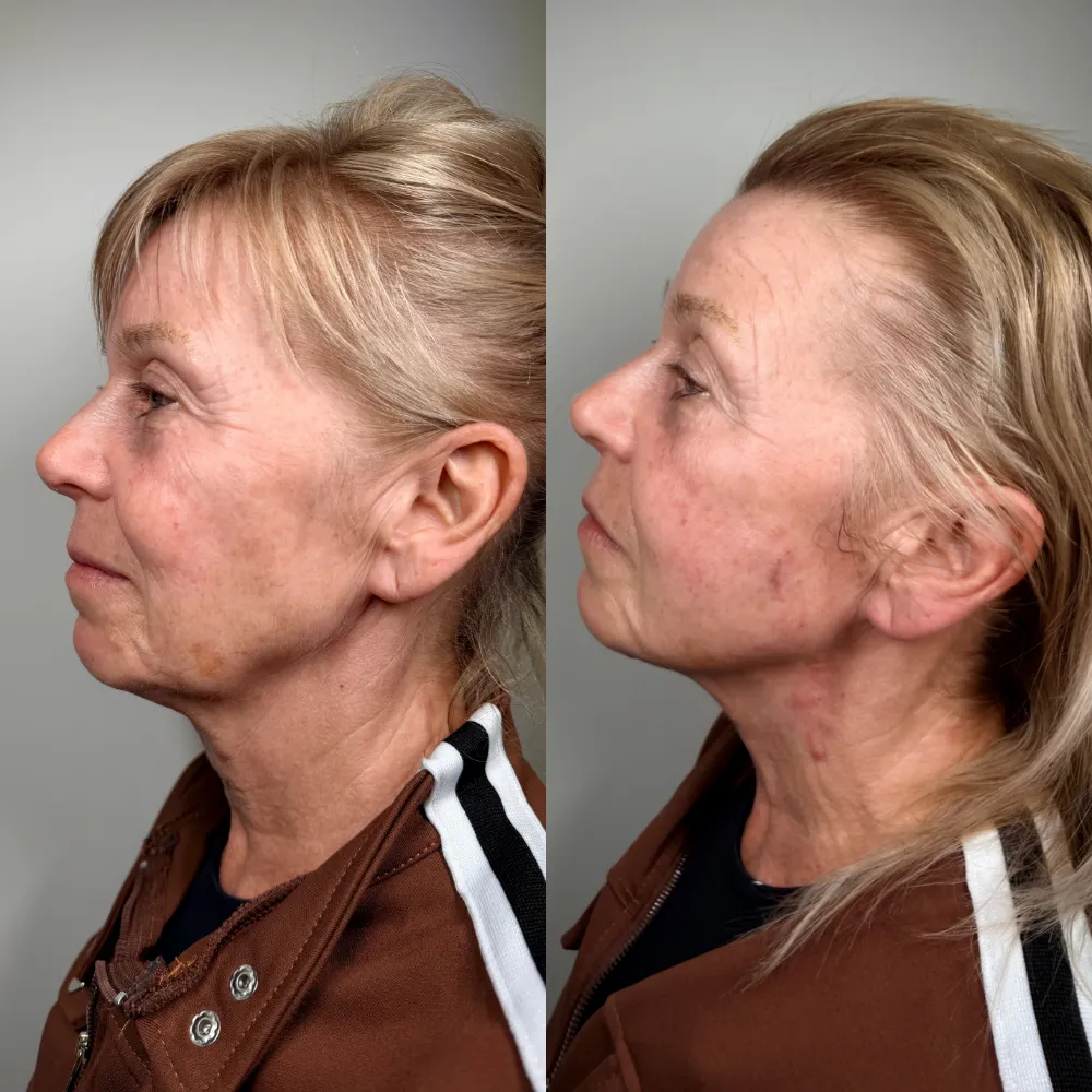 Jawline and Neck, Left Side before and after at The Skin Firm