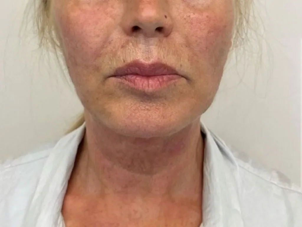 Full Face and Neck, After before and after at The Skin Firm