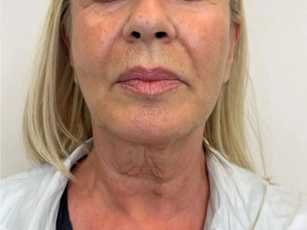 Full Face and Neck, Before before and after at The Skin Firm