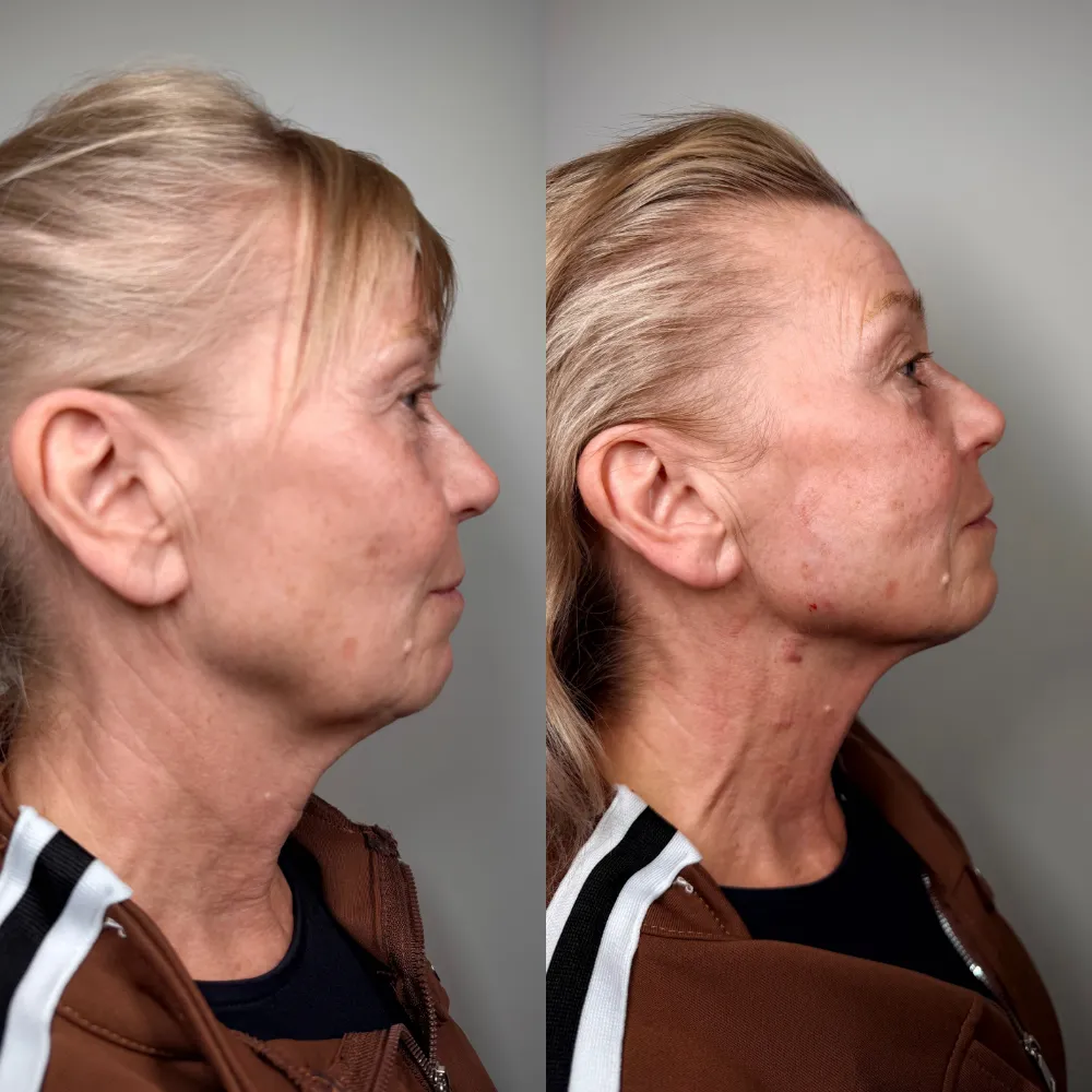 Jawline and Neck, Right Side before and after at The Skin Firm