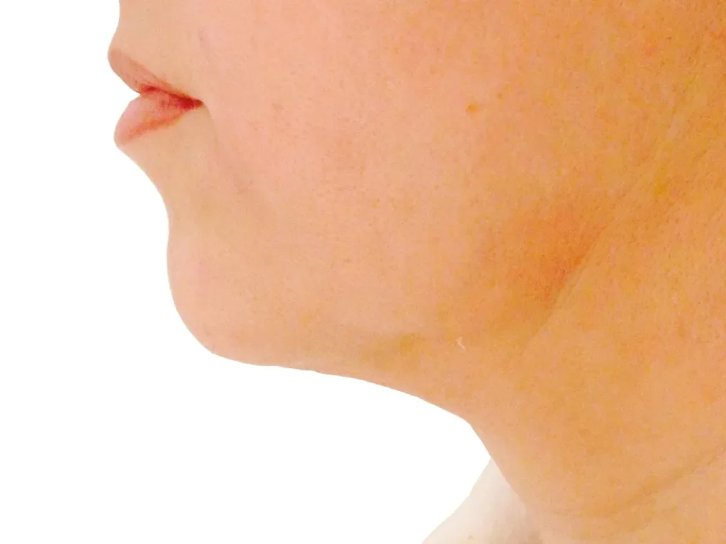 Under Chin, After before and after at The Skin Firm