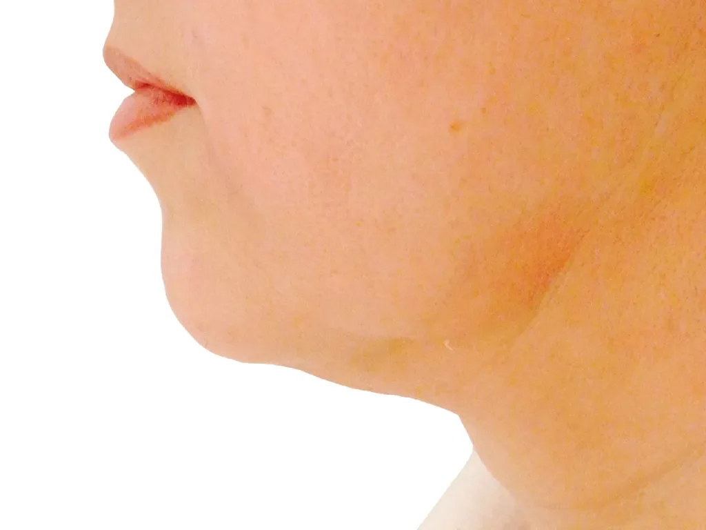 Under Chin, Before before and after at The Skin Firm