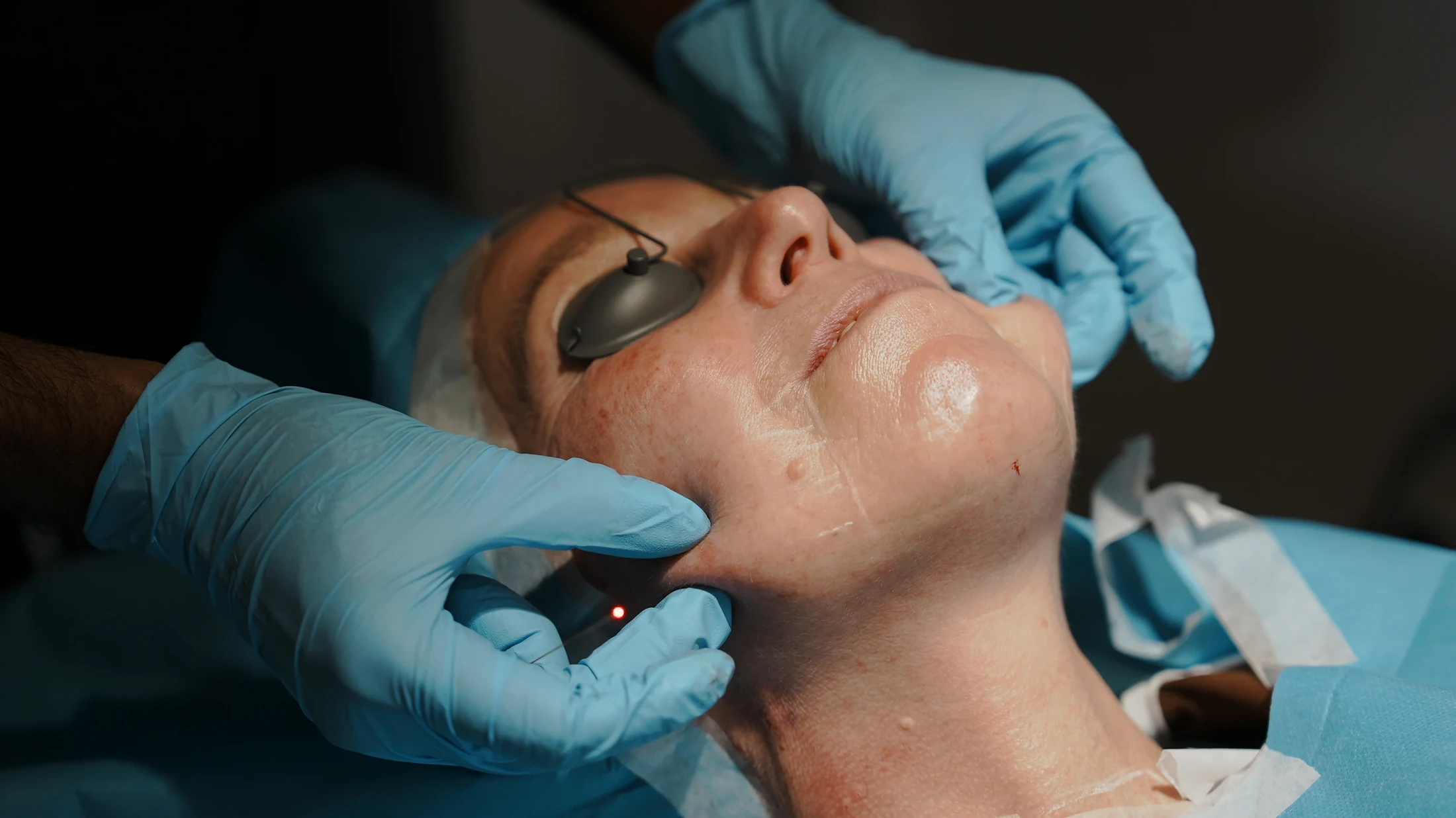 Close-up of Endolift laser treatment along the jawline