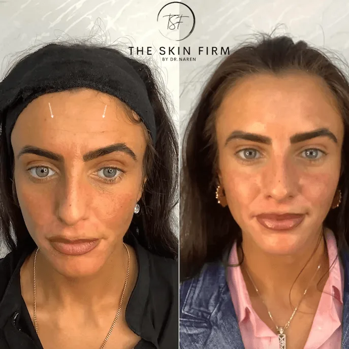 Anti-Wrinkle Treatment Before & After