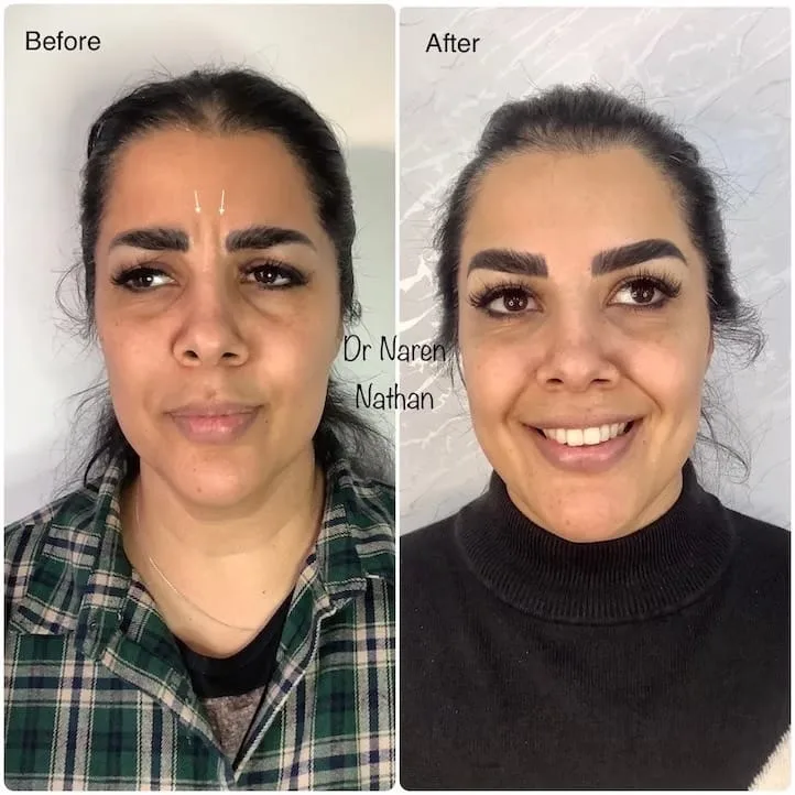 Anti-Wrinkle Treatment Before & After