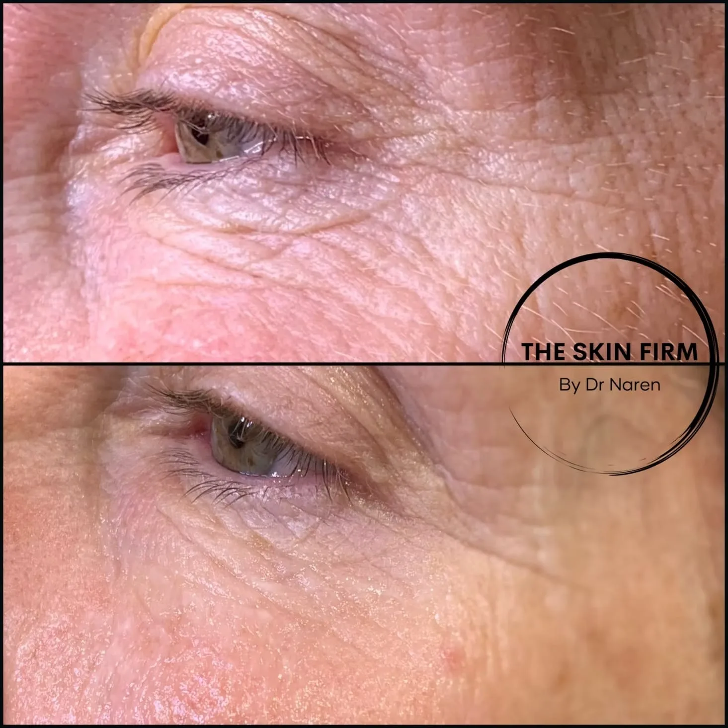 Anti-Wrinkle Treatment Before & After