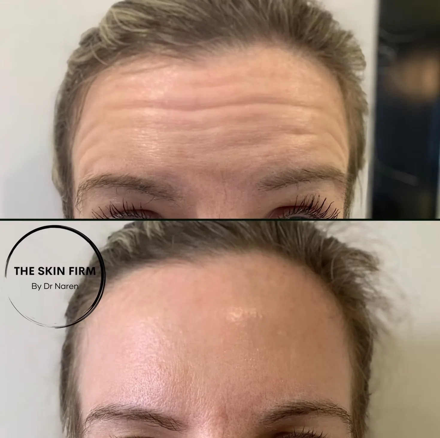 Anti-Wrinkle Treatment Before & After