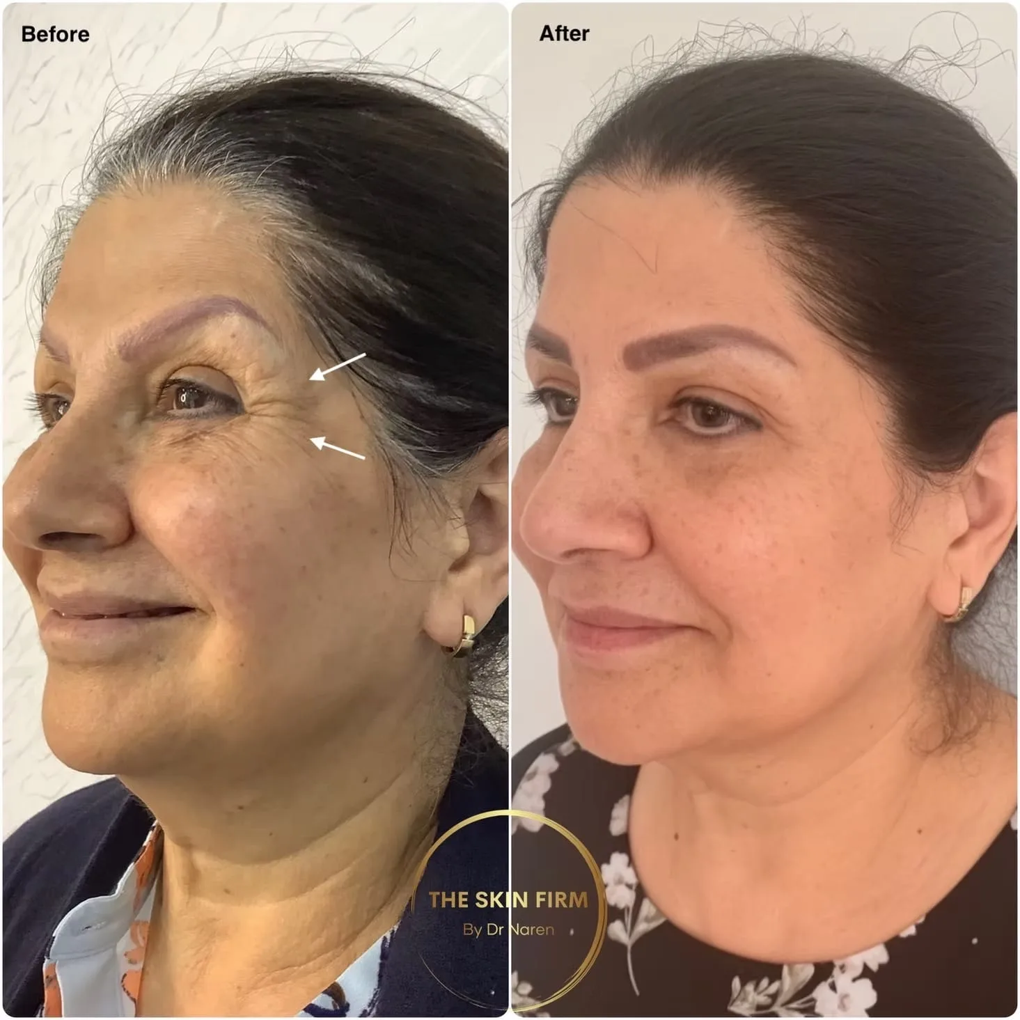 Non-Surgical Facelift Before & After
