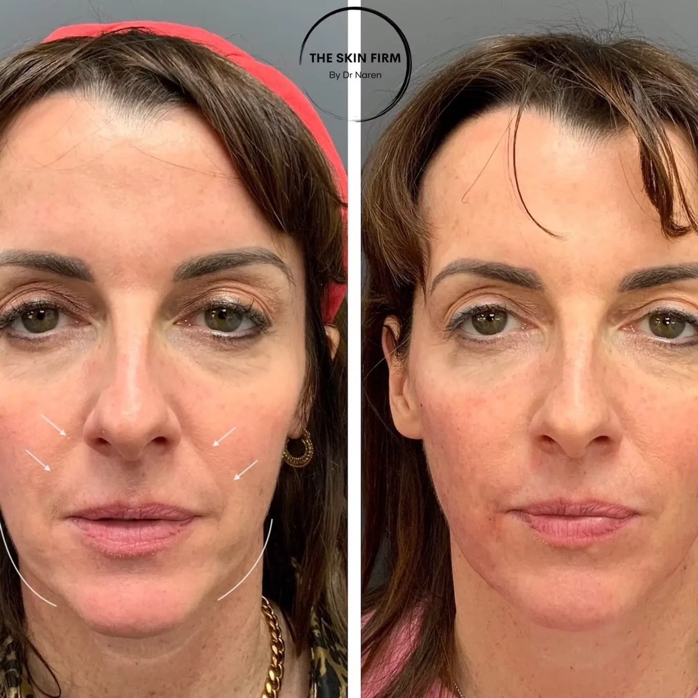 Non-Surgical Facelift Before & After