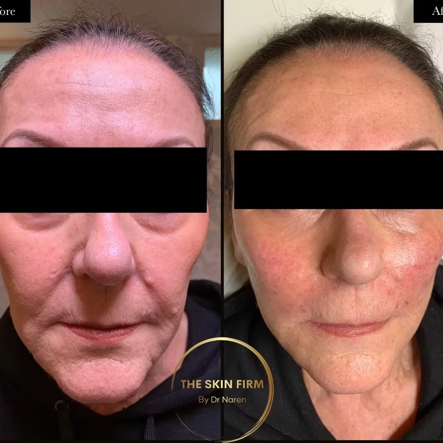 Non-Surgical Facelift Before & After
