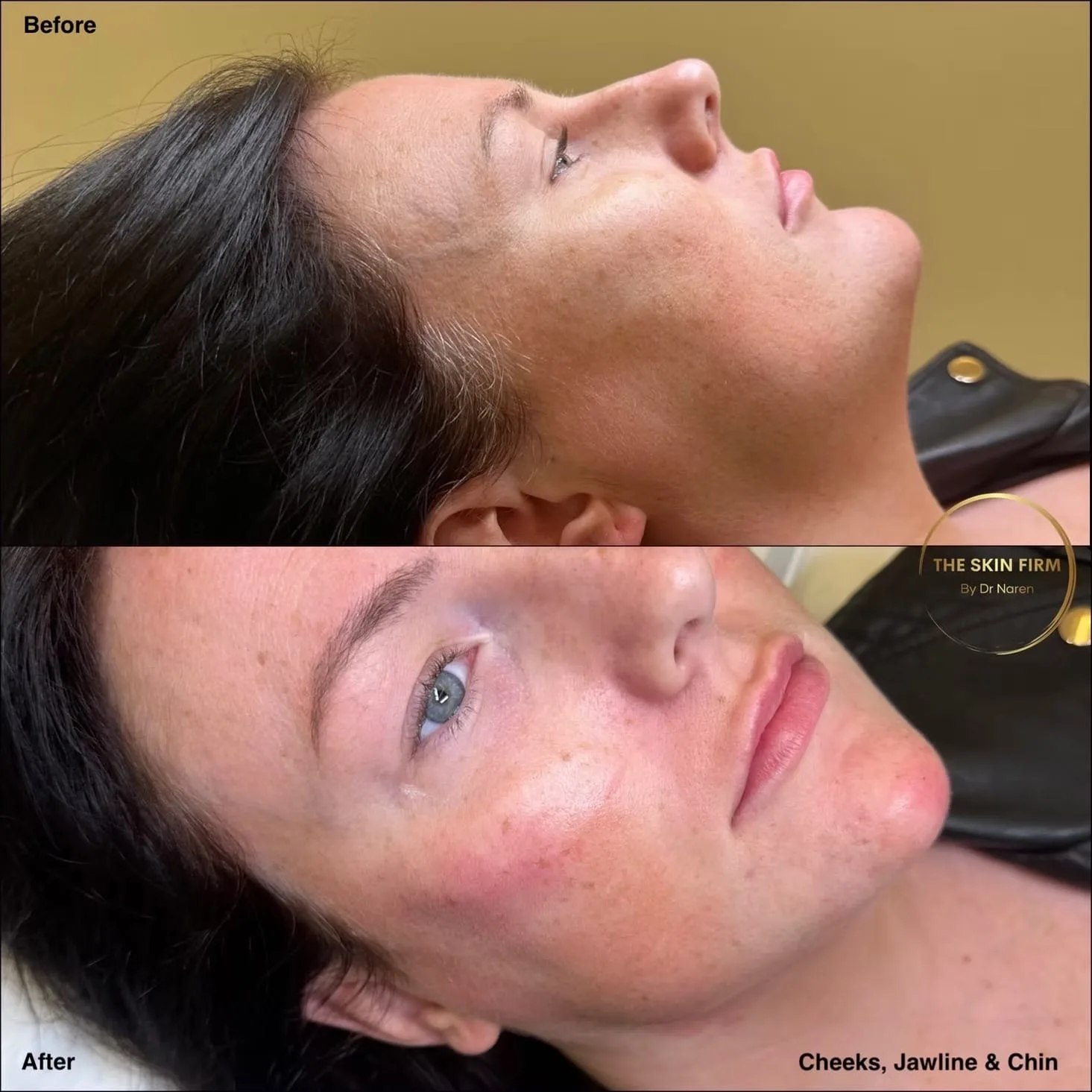 Non-Surgical Facelift Before & After