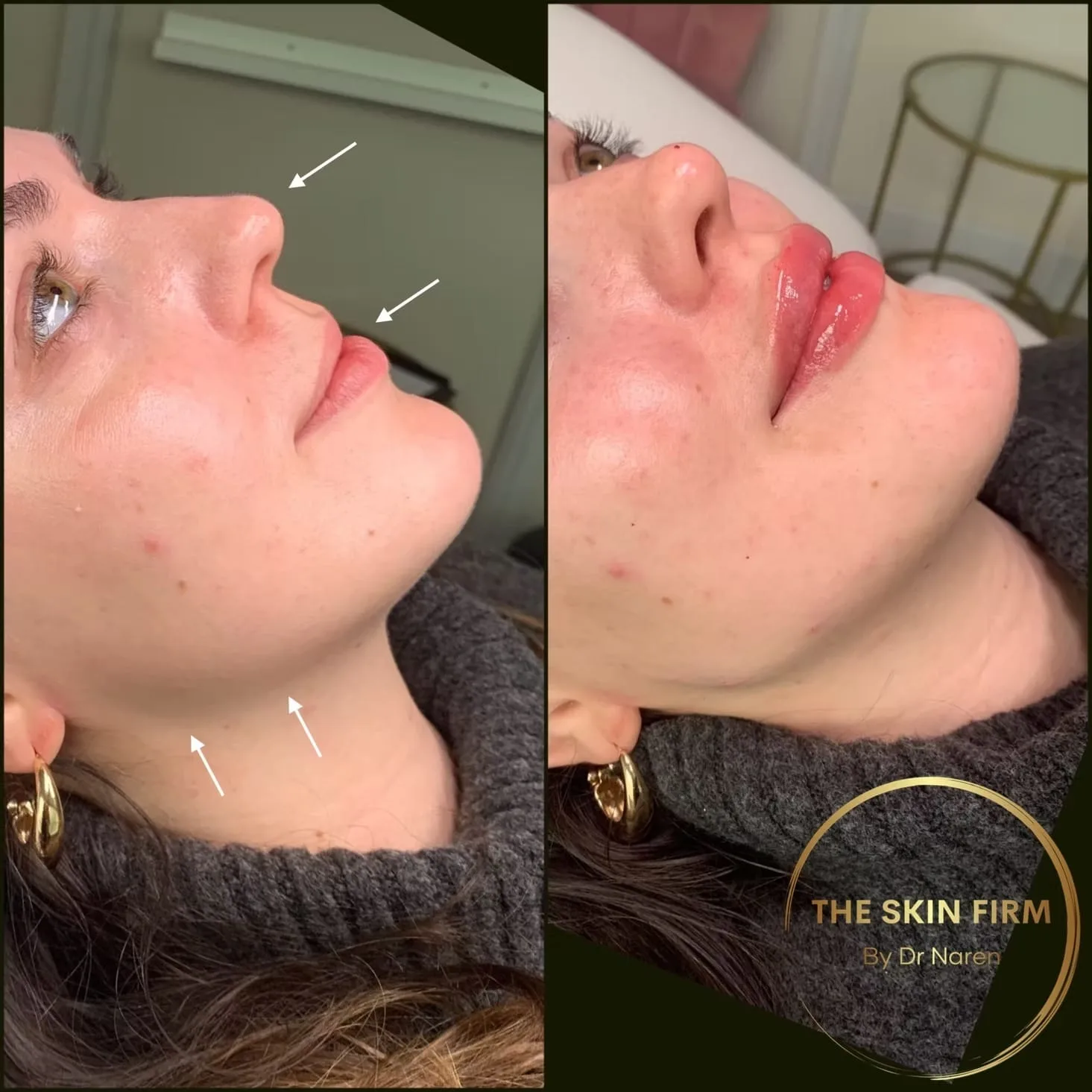 Non-Surgical Facelift Before & After