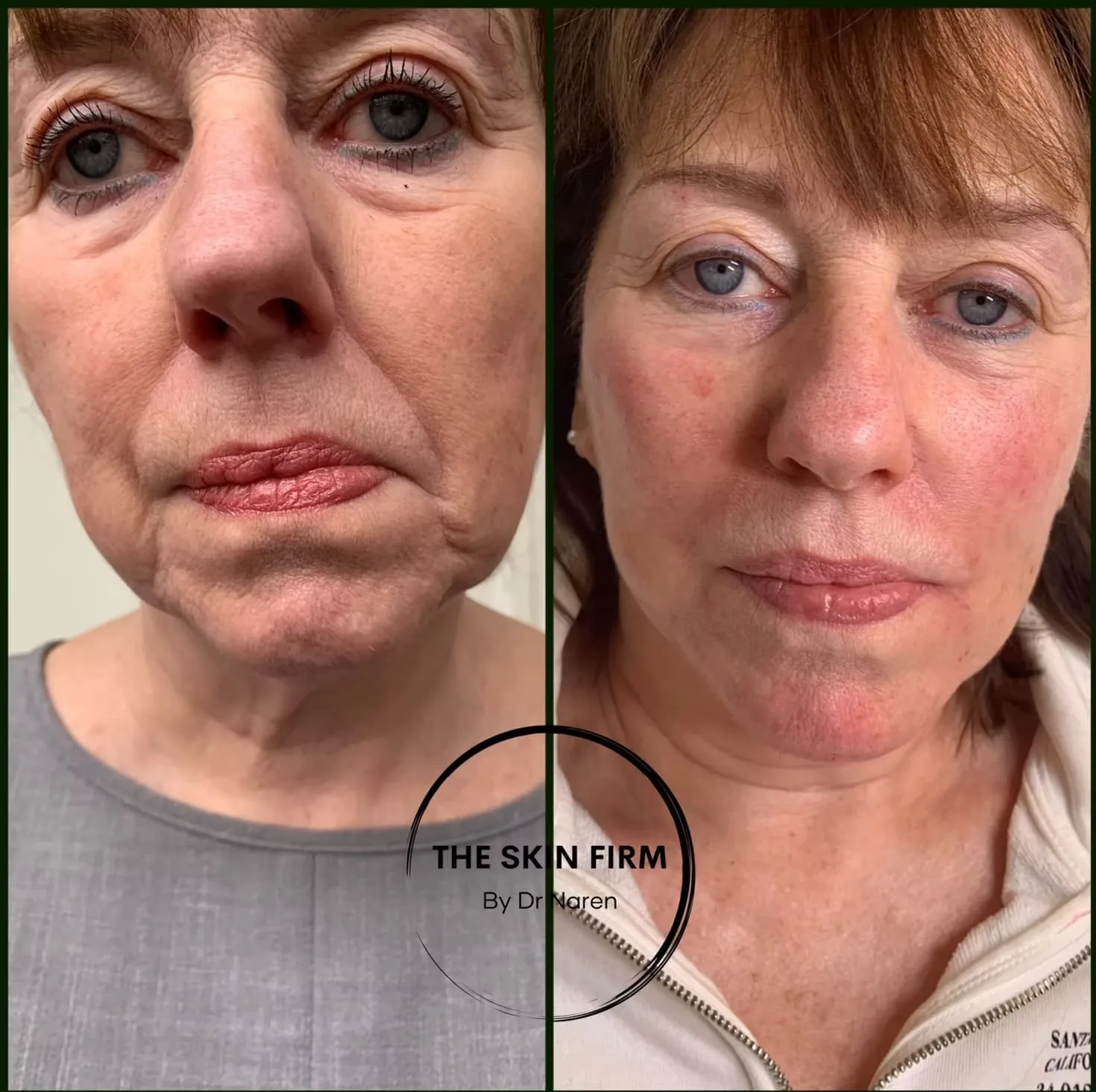 Non-Surgical Facelift Before & After