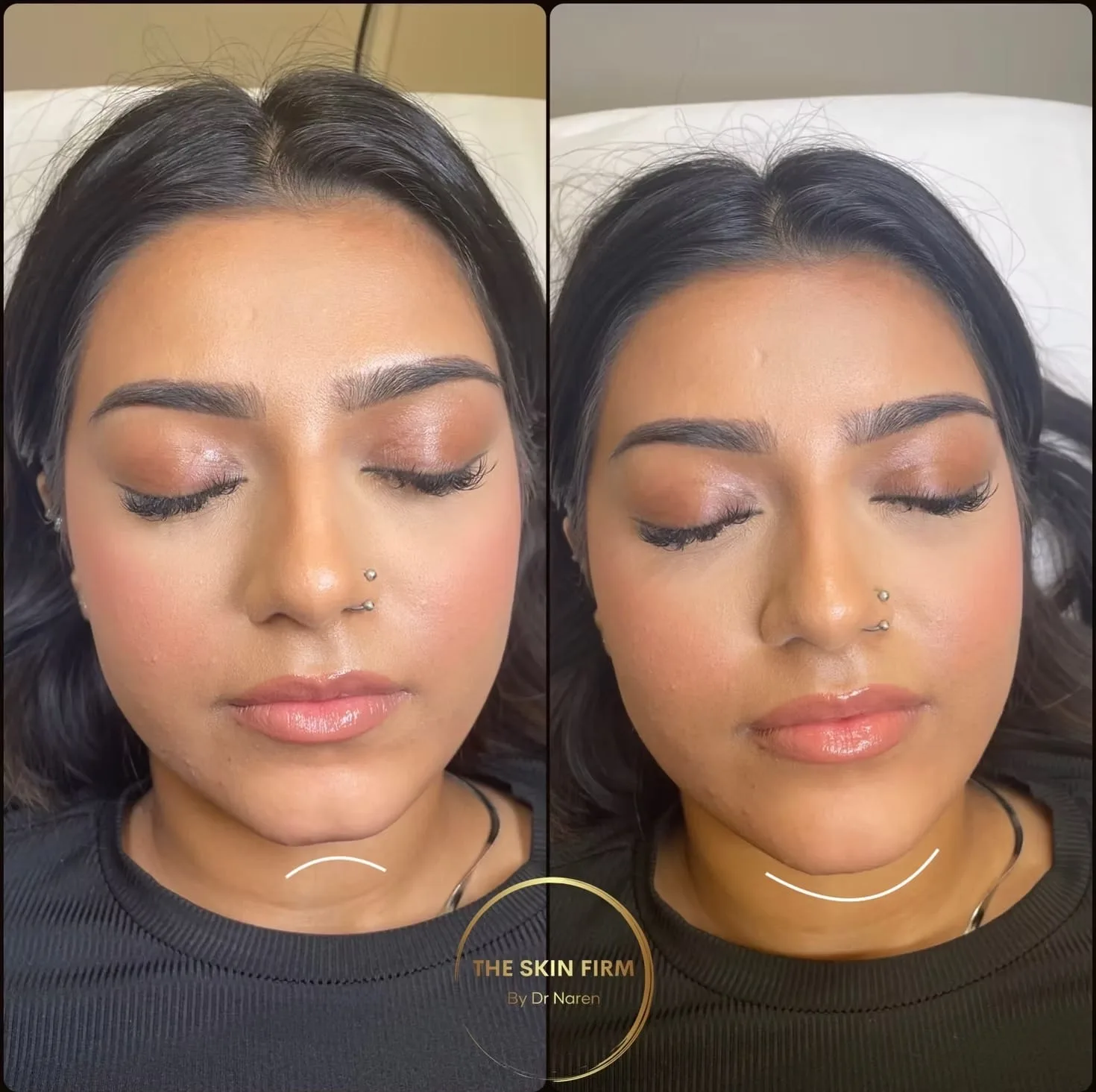 Non-Surgical Facelift Before & After
