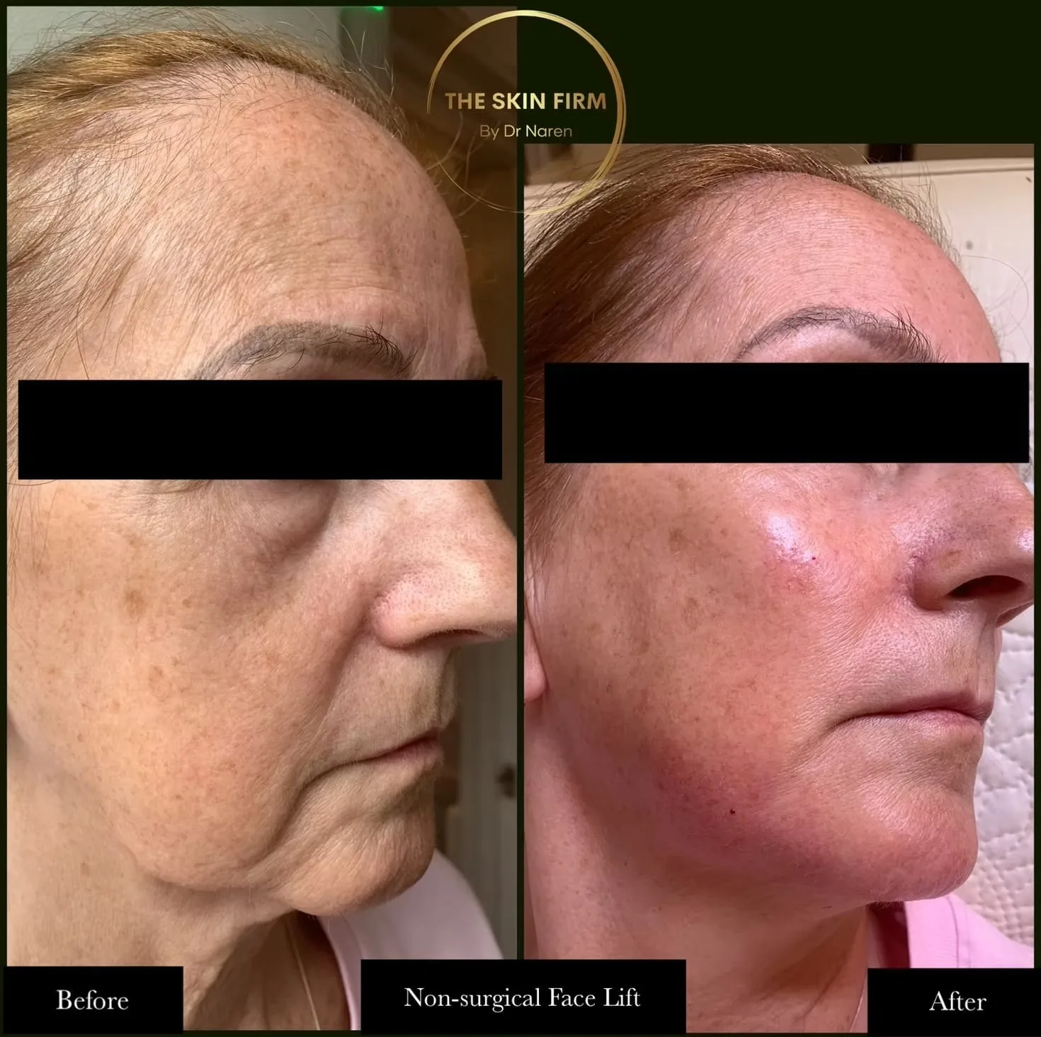 Non-Surgical Facelift Before & After