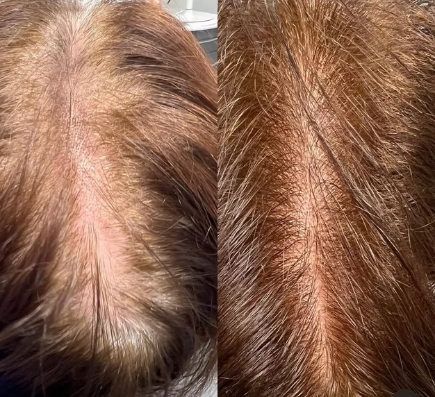 Hair Loss Treatment before and after at The Skin Firm