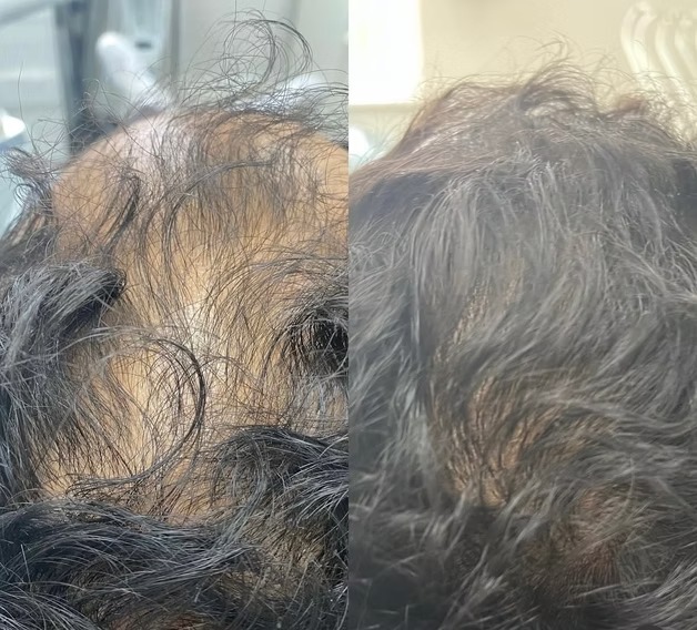 Hair Loss Treatment before and after at The Skin Firm