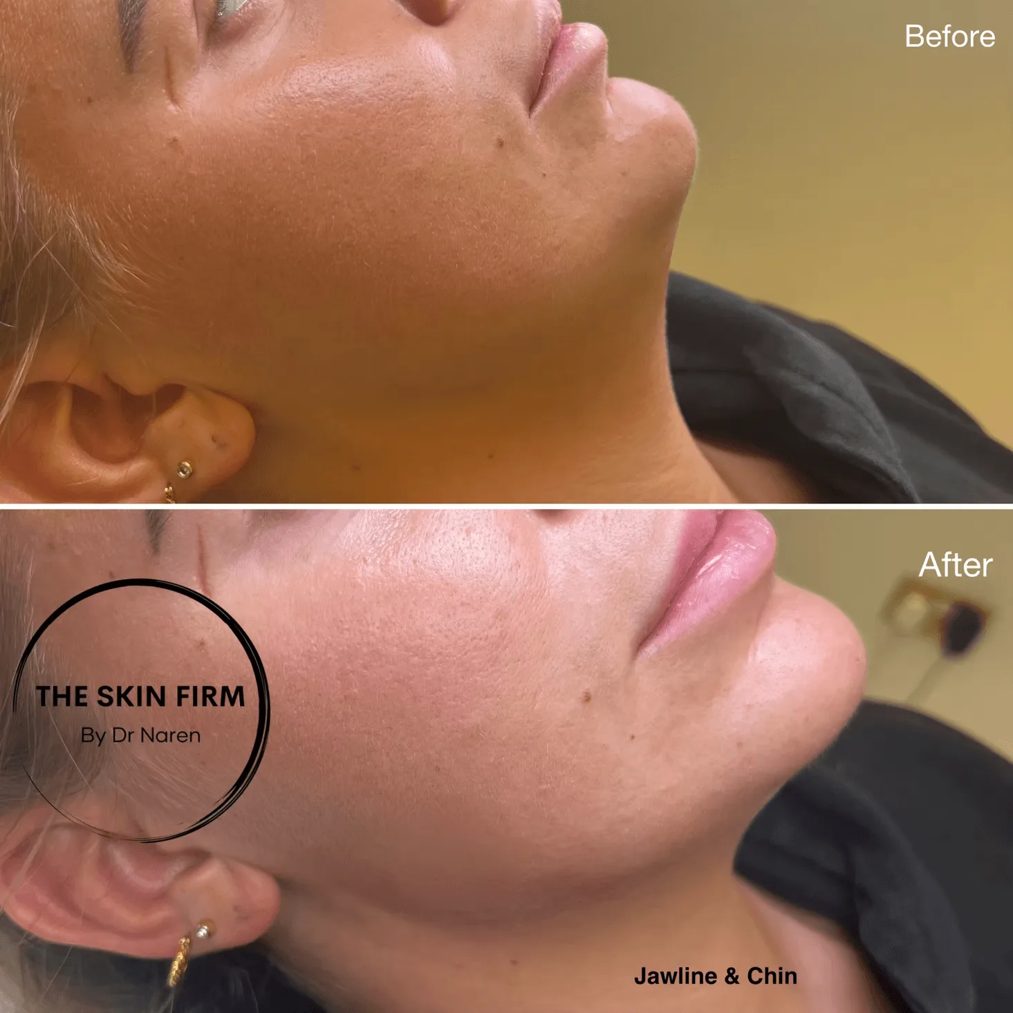 Jawline & Chin Filler Before & After