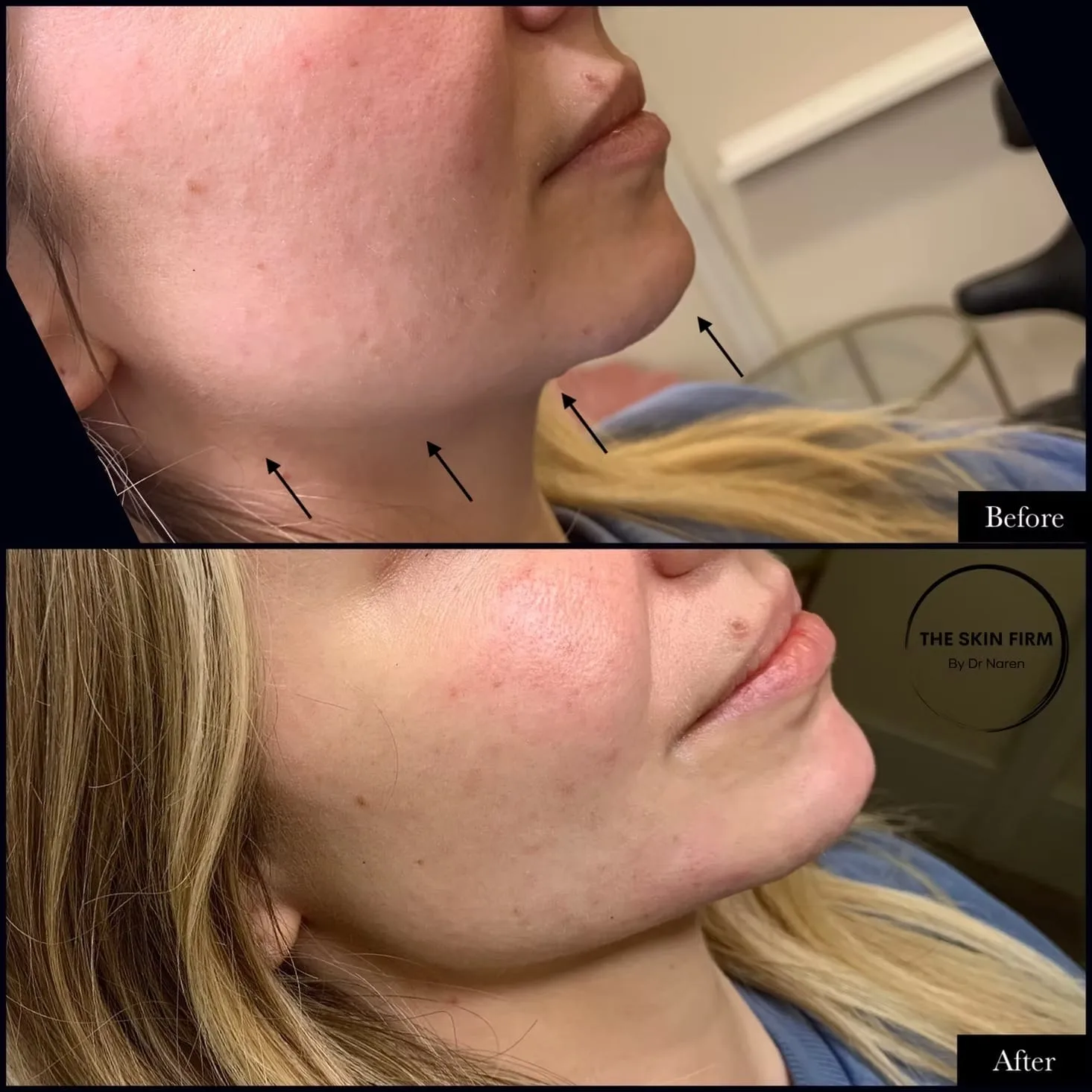 Jawline & Chin Filler Before & After