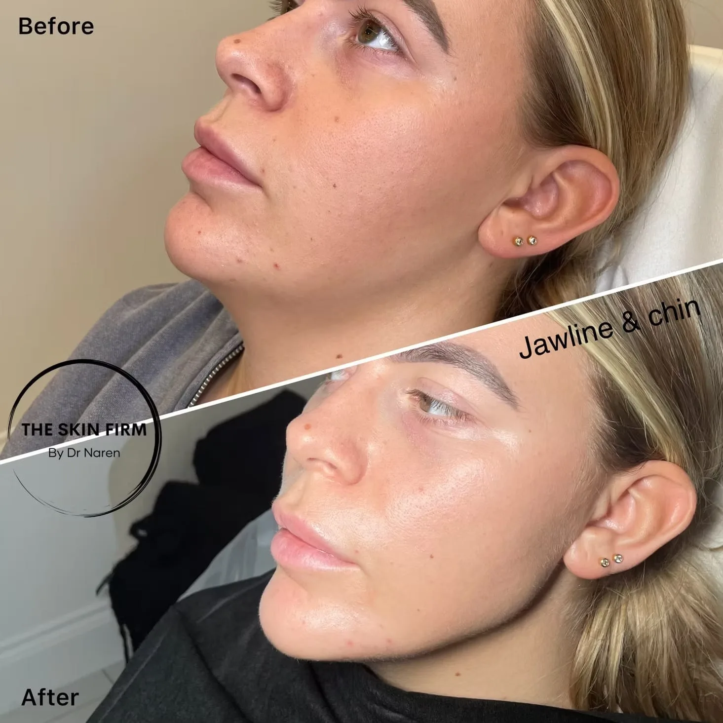 Jawline & Chin Filler Before & After
