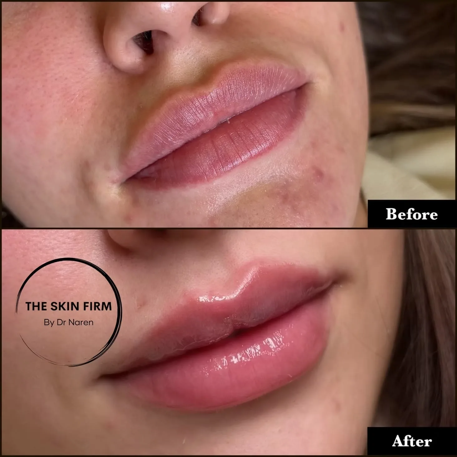 Lip Filler Before & After