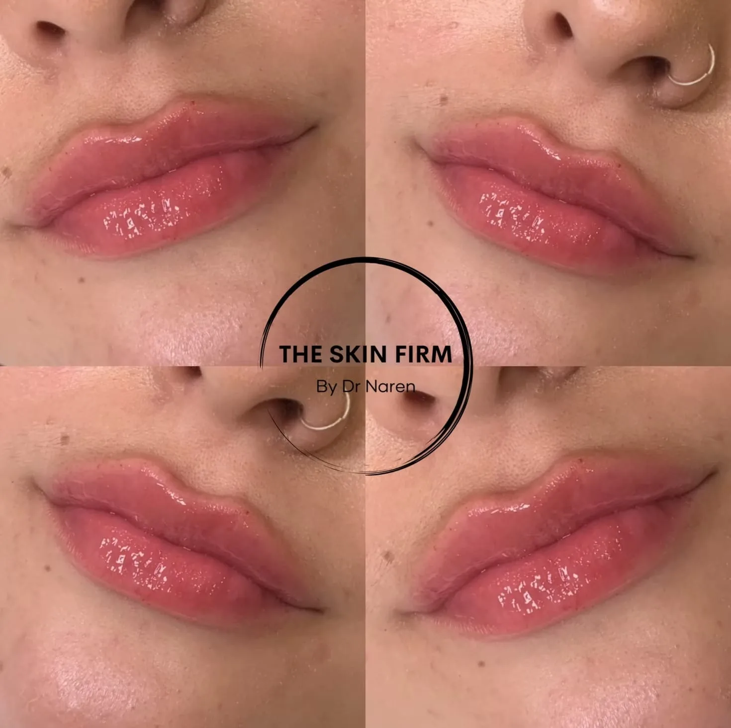 Lip Filler Before & After
