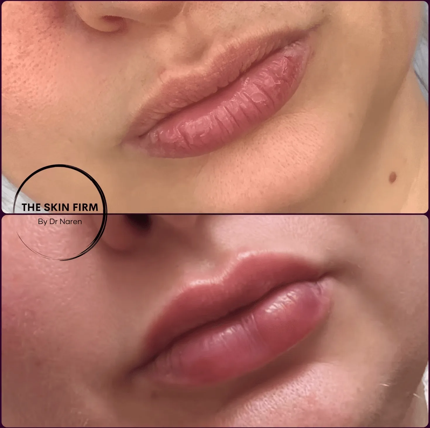 Lip Filler Before & After