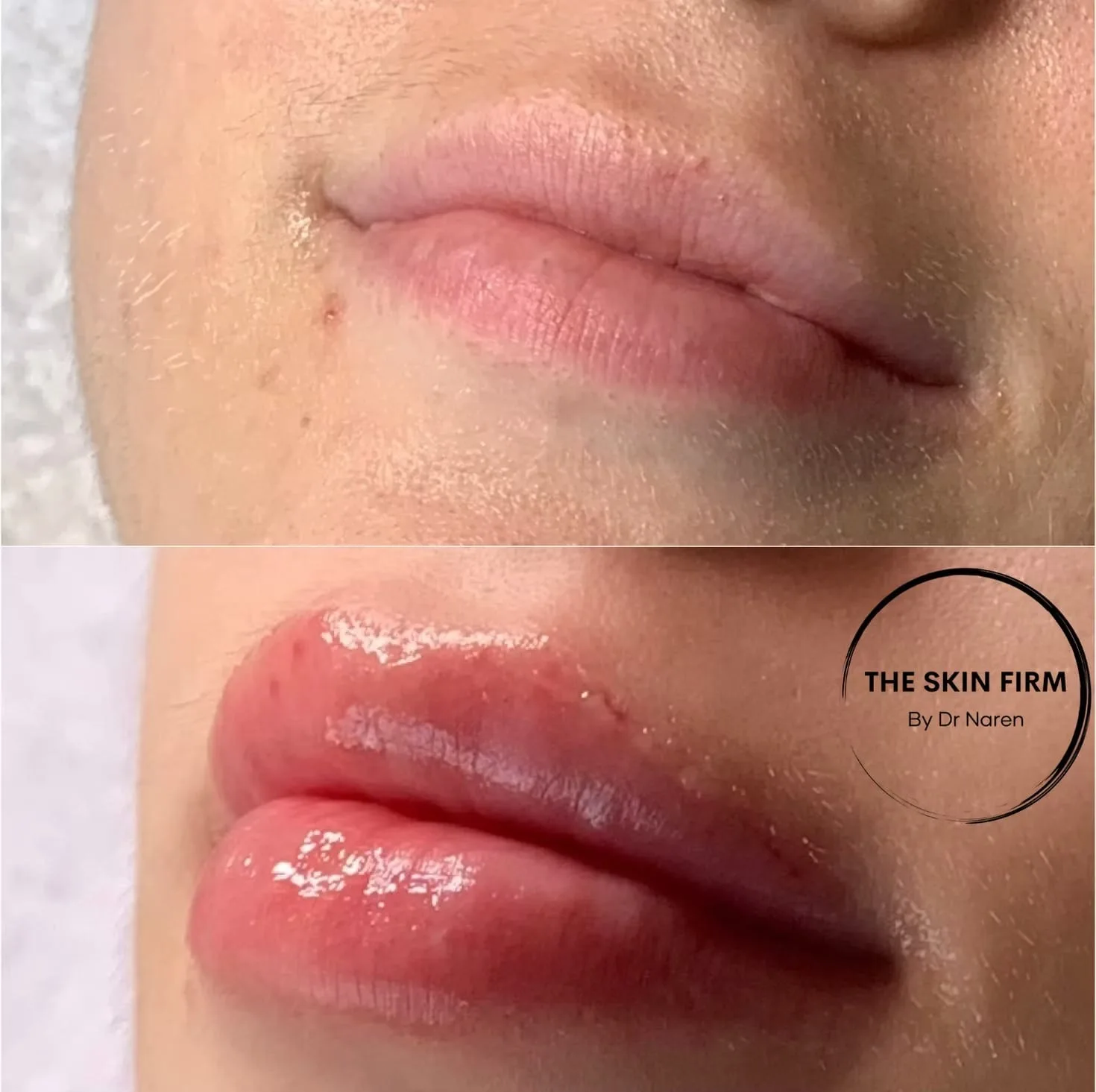Lip Filler Before & After