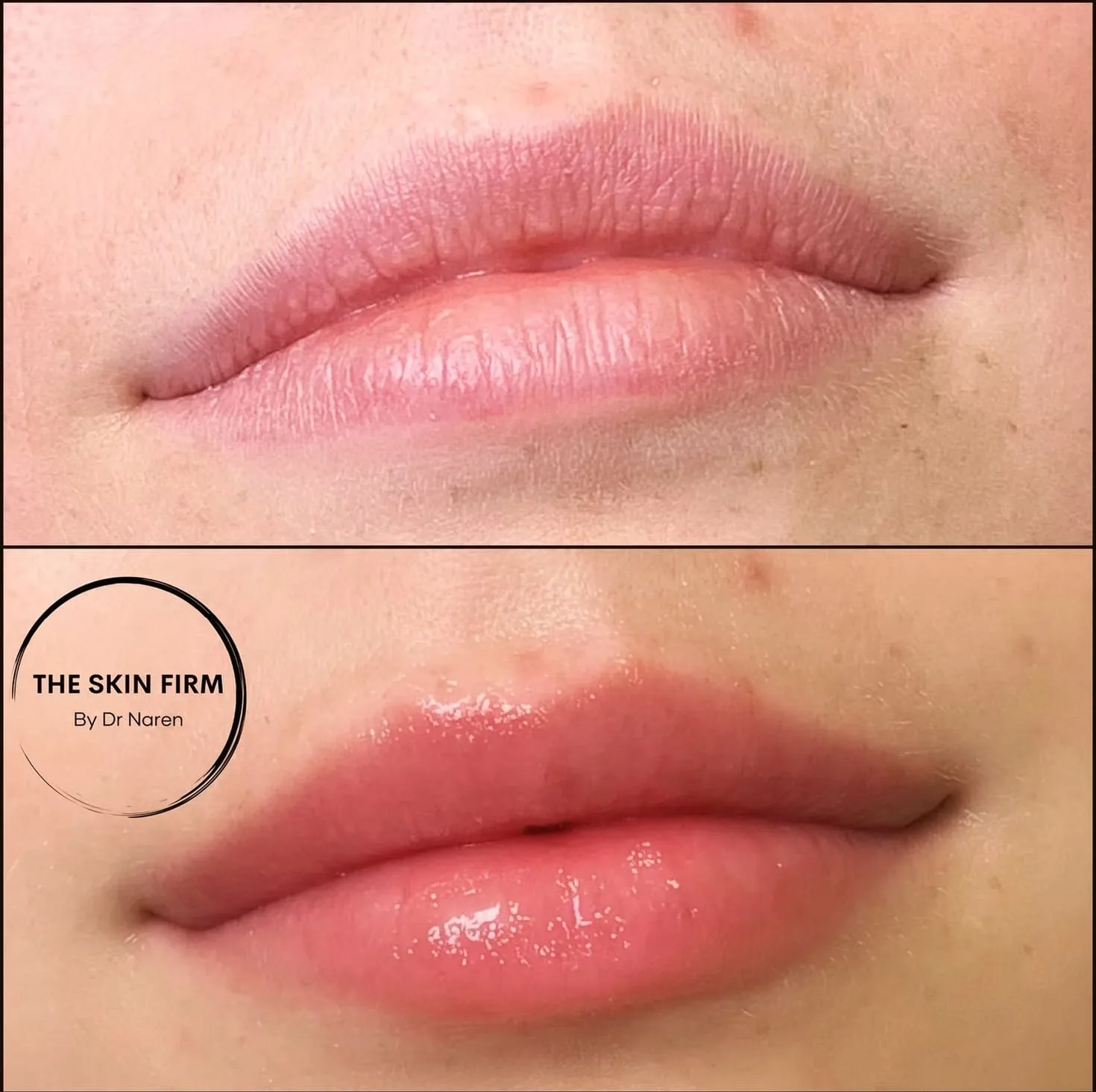 Lip Filler Before & After