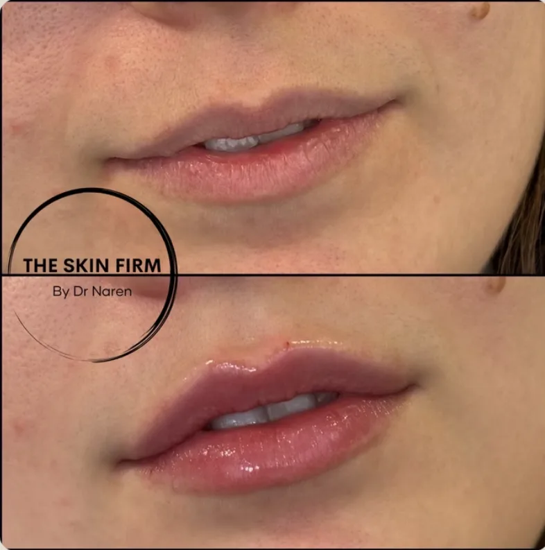 Lip Filler Before & After
