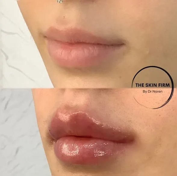 Lip Filler Before & After