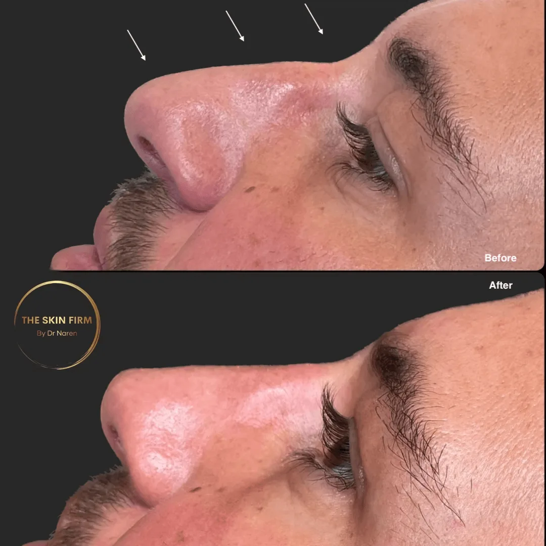 Non-Surgical Rhinoplasty before and after at The Skin Firm