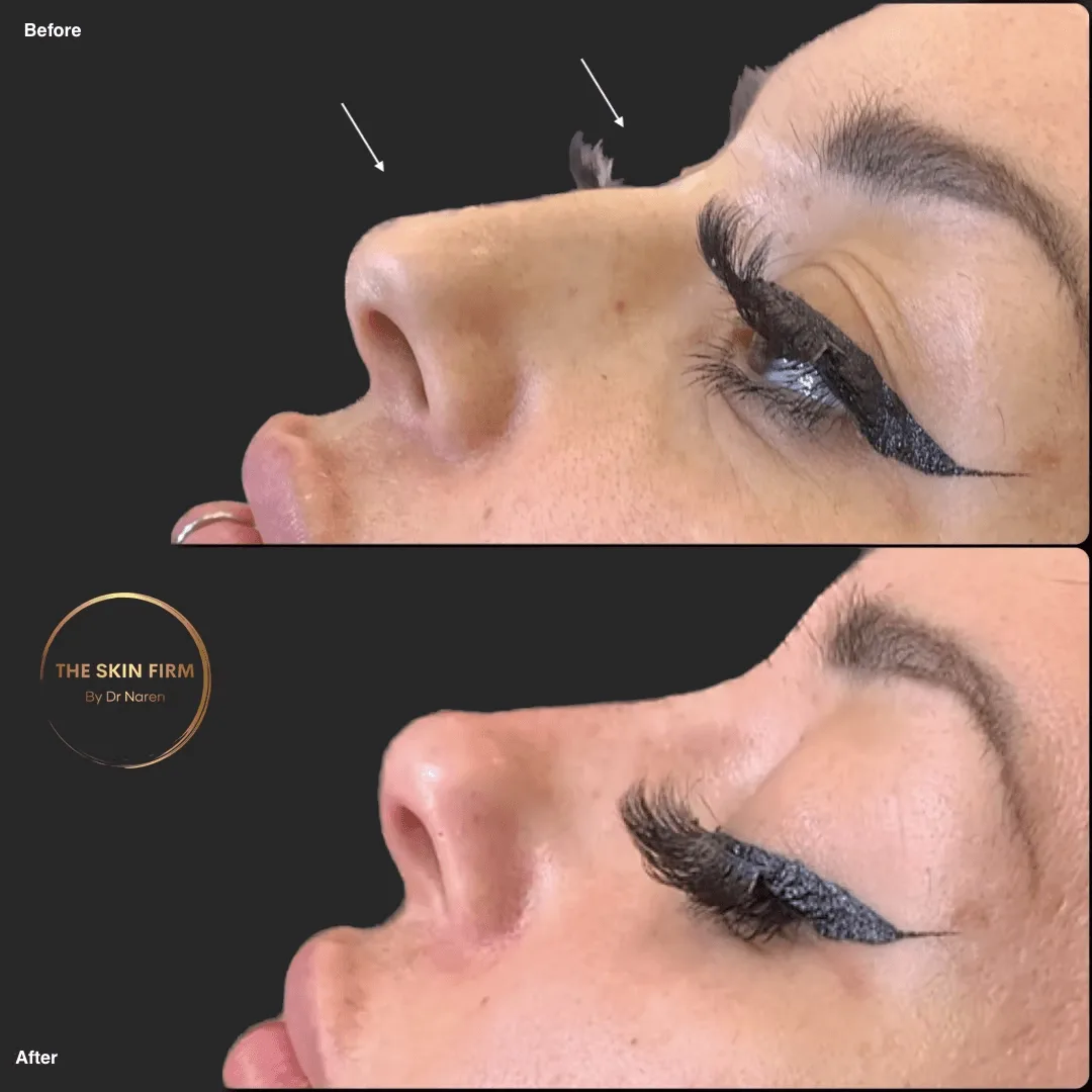 Non-Surgical Rhinoplasty Before & After