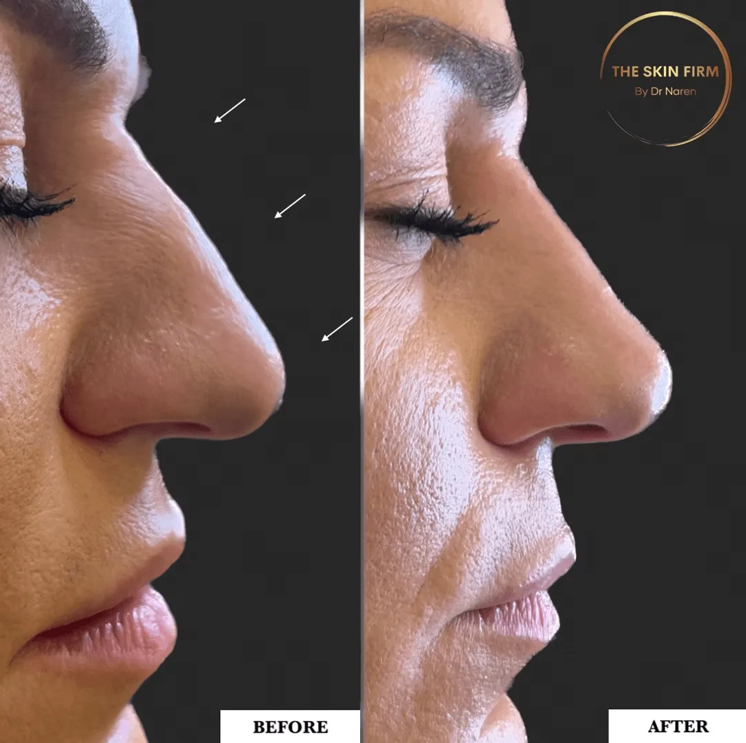 Non-Surgical Rhinoplasty Before & After