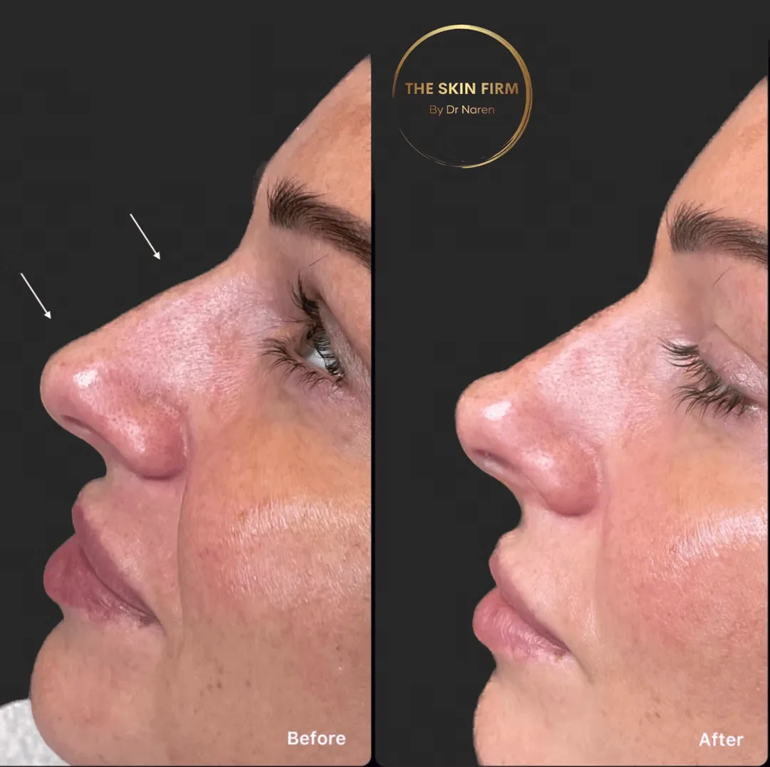 Non-Surgical Rhinoplasty Before & After