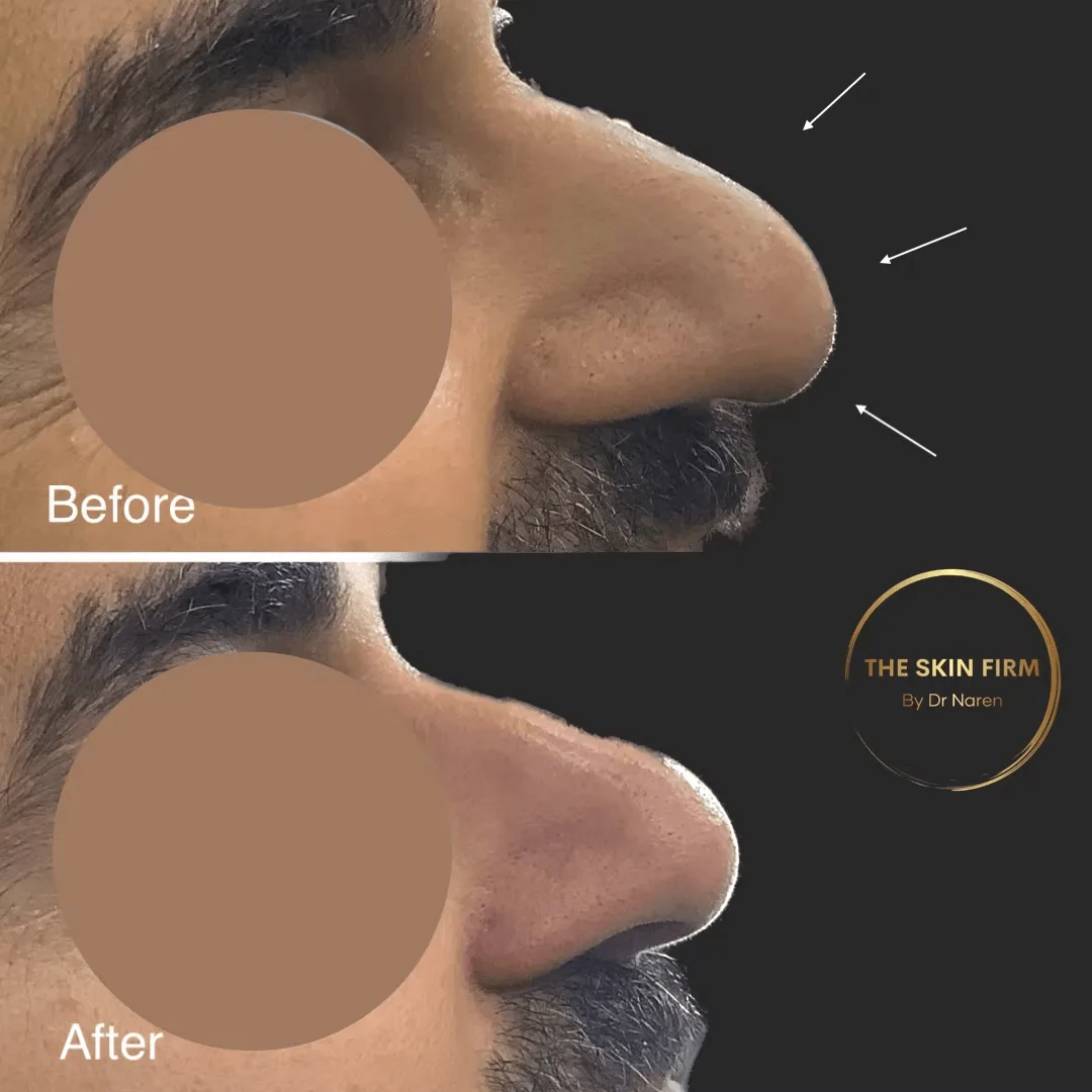 Non-Surgical Rhinoplasty Before & After