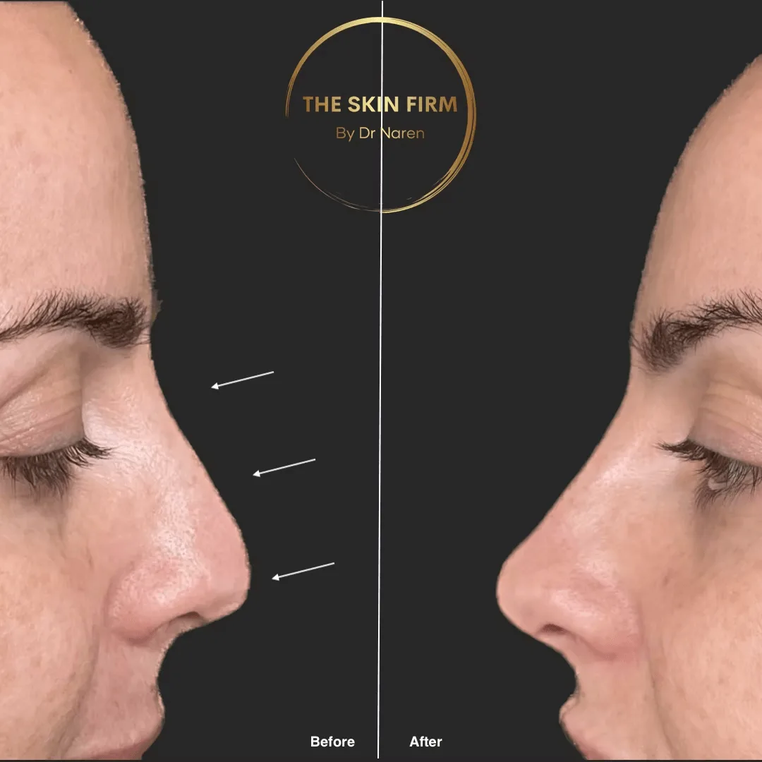 Non-Surgical Rhinoplasty Before & After