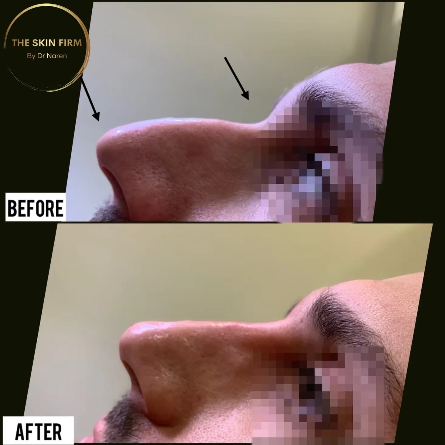 Non-Surgical Rhinoplasty Before & After