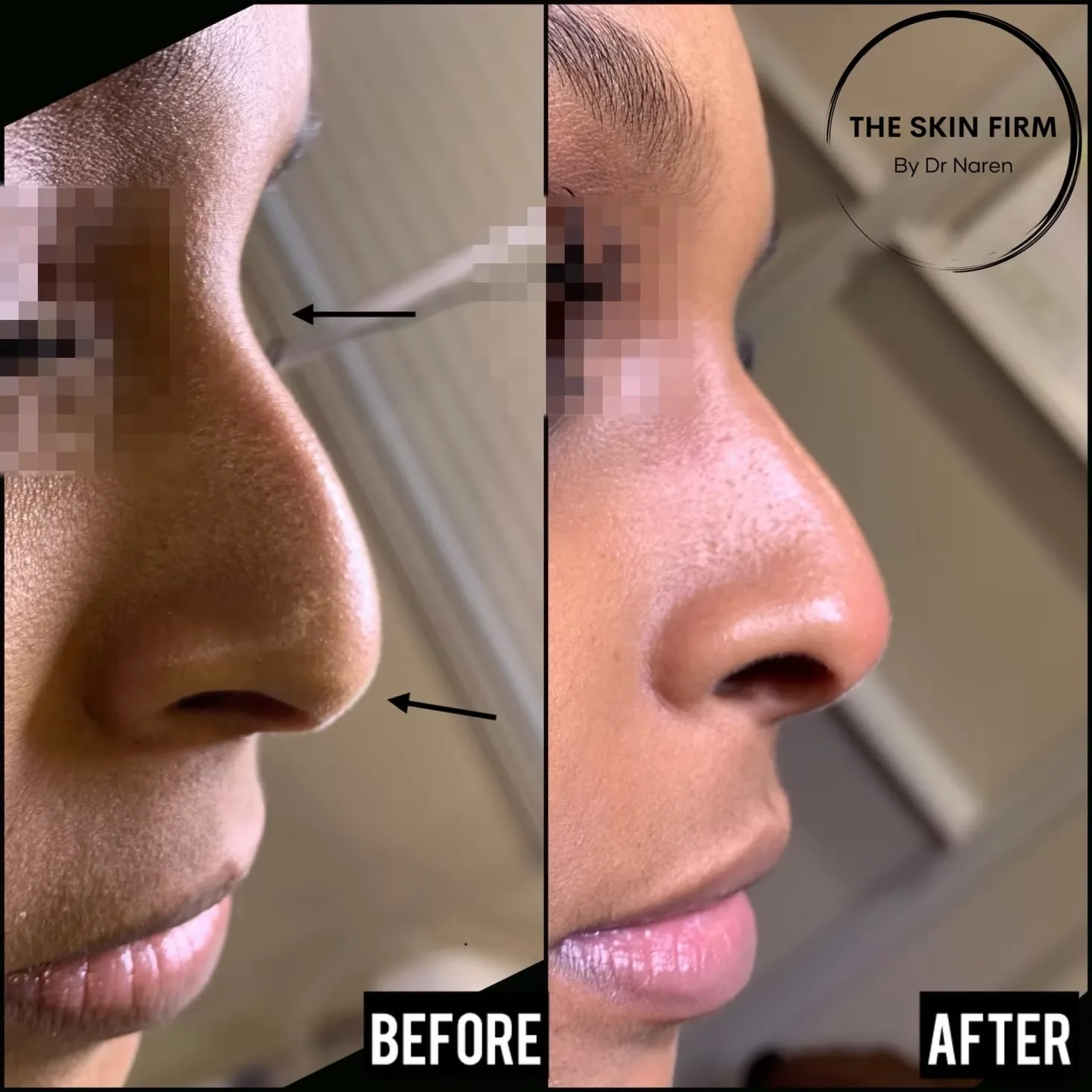 Non-Surgical Rhinoplasty Before & After