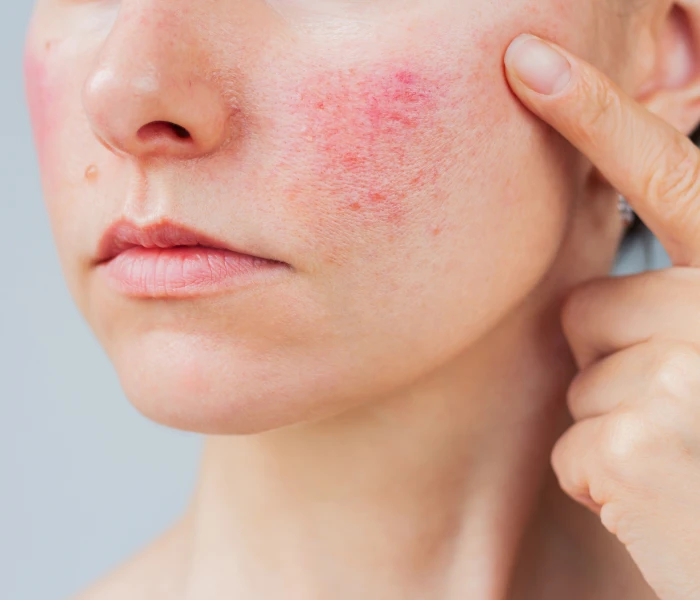 Visible rosacea papules and broken blood vessels on the cheek