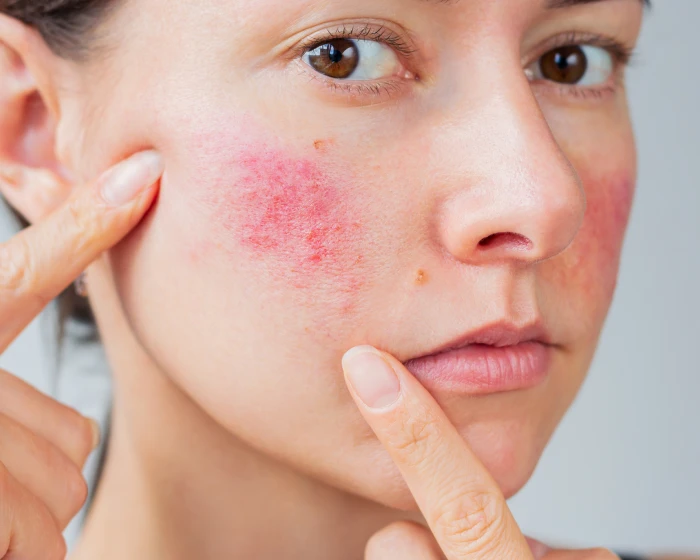 Close-up of facial redness across the cheek, a common sign of rosacea