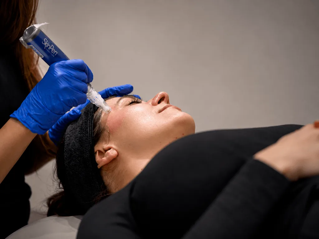 SkinPen Needling